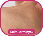 kulit berminyak